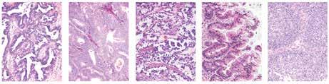 Munasarjakarsinooma Seroosi Endometrioidi Kirkassoluinen Musinoosi Välimuotoinen CK7+ CK20 WT1+ CK7+ CK20 WT1 VIM+ CK7+ CK20 WT1 HNF-1b+ CK7+ CK20+ p53 p53+ Seroosi Endometrioidi Kirkassoluinen