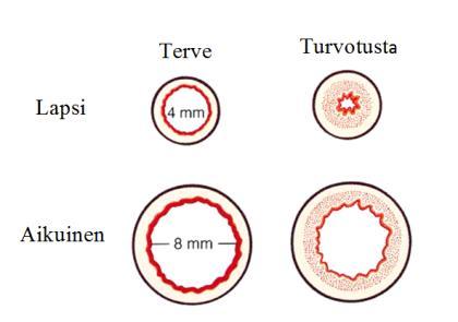 16 KUVA 3. Lapsen ja aikuisen henkitorven halkaisijan vertailua (mukaillen Bertroche 2015) Trakeostomoidulla lapsella henkitorven läpimitalla on suuri merkitys (kuva 4.). Henkitorven läpimitta määrää trakeostomiakanyylin koon.
