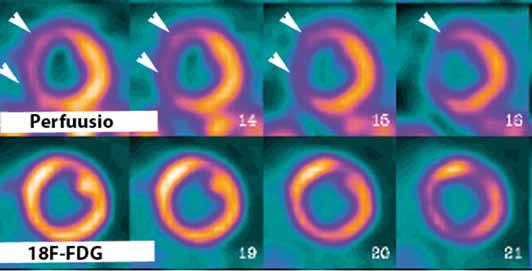 Kuva 1. Sydämen perfuusiotutkimus 201 talliumisotoopilla (ylhäällä) osoittaa arpikudokseen sopivan septaalisen perfuusiopuutosalueen.
