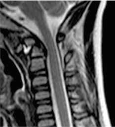 A B KUVA 4. Viisivuotiaan spondyloepifyseaalista dysplasiaa sairastavan pojan kaularangan taivutusmagneettikuva.