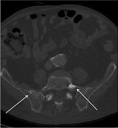 Ekstramedullaarinen hematopoieesi on erotusdiagnostinen vaihtoehto, johon liittyvä massa voi välikarsinan takaosassa olla molemminpuolinen mutta myös toispuolinen. KUVA 2. TT-kuva.