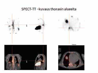 KLIINIS-PATOLOGINEN KOKOUSSELOSTUS KUVA 5. SPECT-gammakuvaus teknetiumilla merkityllä nanokolloidilla.