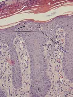 KATSAUS Neutrofiili Lymfosyytti * KUVA 1. Psoriaasin histologia.