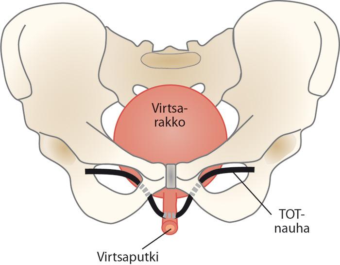 Mini-invasiiviset toimenpiteet ponnistusvirtsankarkailun leikkaushoidossa Kaavakuva