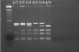 19 7.2 Laboratoriomenetelmät DNA:n eristys EDTA-laskimoverinäytteestä tehtiin kaupallisen QIAamp DNA Blood mini kit (QiaGen) menetelmää käyttäen.