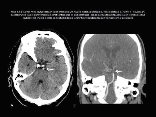 TT-angiografia Laskimonsisäiseen liuotushoitoon tai trombektomiaan mahdollisesti soveltuville aivoinfarktipotilaille suositellaan heti natiivi-tt:n jälkeen tehtäväksi samalla kertaa aivo- ja