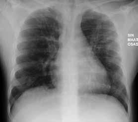 G H I J K L la läiskäistä mattalasia ja hentoja konsolidaatioita. Molemmin puolin keuhkokuvioitus on korostunutta keuhkoportin alueella. Lapsi kotiutettiin kolme vuorokauden kuluttua.