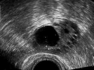 B) Monofollikulaarinen ovulaatio palauttaa hormonitasapainon. C) IVF-stimulaatio: monirakkulainen vaste, suuret estrogeenipitoisuudet.