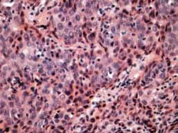 A B Kuva 2. Suunielun huonosti erilaistunut keratinisoitumaton levyepiteelikarsinooma.