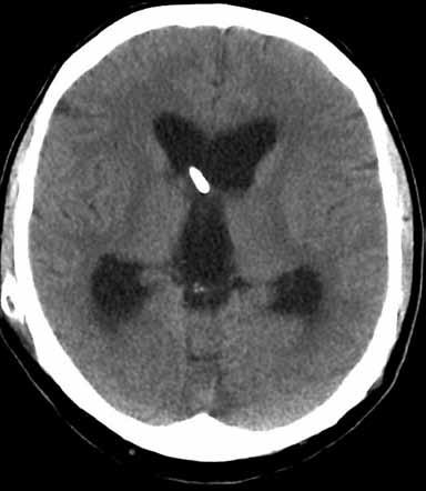 Näitä tutkimuksia käytetään neurokirurgin harkinnan mukaan lähinnä ratkaisemattomissa tilanteissa, joissa sunttirevisiota ei perustutkimusten jälkeen katsota riittävän aiheelliseksi.