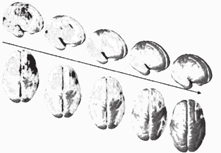 ajan sekä kokonaisuudessaan että aivojen eri osissa (Paus 2008, Wilke ym. 2007, Lenroot ym. 2007). Aivohermot myelinisoituvat ensimmäisinä, tyypillisesti viidennellä raskauskuukaudella.