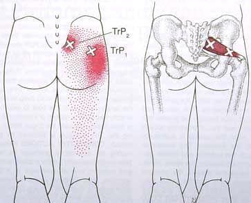 Triggerpisteen itsehoito, pakaran seudun lihakset Triggerpisteet ovat lihaksessa tai lihaskalvossa olevia ärsyyntyneitä alueita.