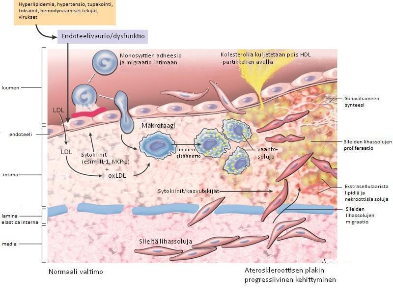 12 KUVA 3. Aterogeneesi (muokattu lähteestä Mitchell & Schoen 2010) Muun muassa hyperlipidemia ja hypertensio johtavat valtimon endoteelin vaurioon ja dysfunktioon.