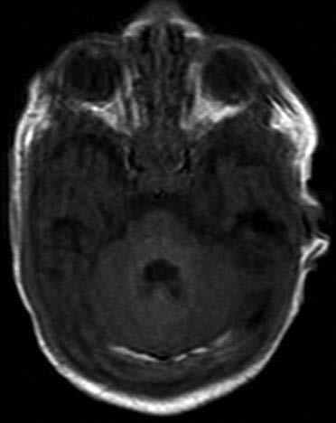 Harvinainen Trauma Traumaattinen