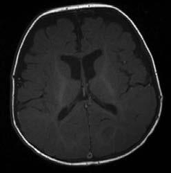 2kk Massaleesio, oudot kystat Medulloblastooma yleisin vuotava tuumori Tuumorit Paineinen likvorkierron häirö MRI ei ole