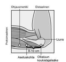 Kuva 2a Kuva 2b Merkitse steriilillä merkintäkynällä kaksi merkkiä: merkitse ensin implantaatin asetuskohta ja merkitse toiseksi kohta, joka sijaitsee proksimaalisesti muutaman senttimetrin päässä