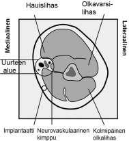 puudutussuihkeella tai injisoimalla 2 ml 1 % lidokaiinia ihon alle suunniteltua asetuslinjaa pitkin). Poista implantaatin sisältävä steriili, kertakäyttöinen Nexplanon-asetin läpipainopakkauksesta.