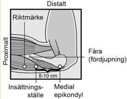 Figur 2a Figur 2b Gör två markeringar med en steril markör: markera först punkten där implantatet ska sättas in, markera sedan en punkt några centimeter proximalt från den första punkten (Figur 2a).