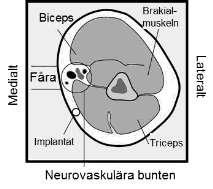 med anestesispray eller genom att injicera 2 ml 1% lidokainlösning under huden längs med den planerade insättningskanalen ).