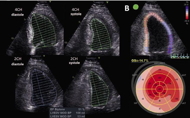 A B C Kuva 1. Vasemman kammion systolisen toiminnan arviointi ultraäänitutkimuksessa.