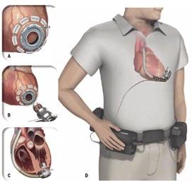 on mekaaninen sydänläppä, voidaan aorttapositioon asentaa samalla bioläppä.
