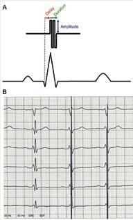 V:n signaalit alkavat, kun on kulunut n. 30 ms QRS-kompleksin alusta (Kuva 2).