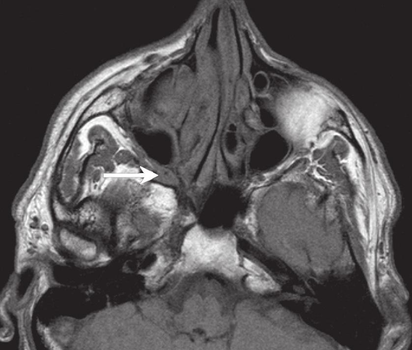 KUVA 3. T1-magneettikuva osoittaa sylkirauhasperäisen adenokystisen karsinooman leviämisen hermoa pitkin fossa pterygopalatinassa oikealla puolella (nuoli).