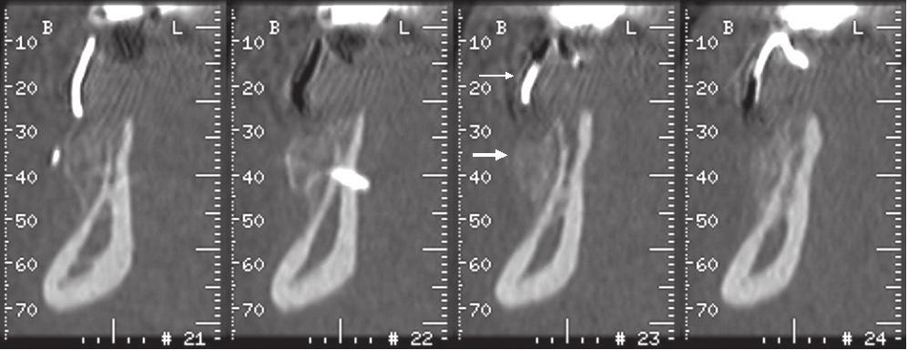 KUVA 10. Dentascan-tietokonetomografia implanttisuunnittelussa. Dentascan-ohjelman avulla saaduista poikittaisleikkeistä, voidaan arvioida luuharjanteen mitat implantointia varten.