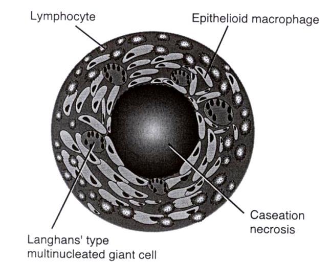 Epitelioidisolut muistuttavat siis epiteelisoluja. Ne eivät ole epiteliaalista alkuperää. Niissä on vesikulaarinen tuma ja runsas eosinofiilinen sytoplasma.