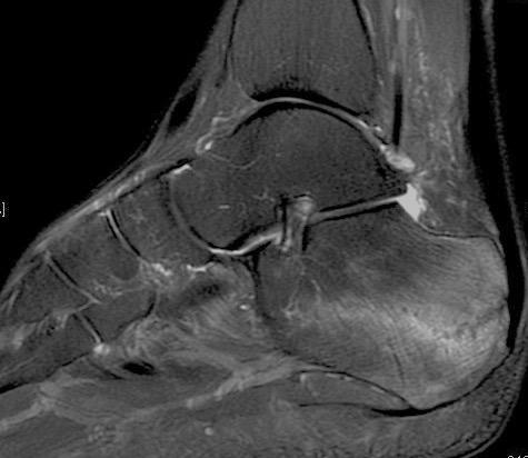 Kirjallisuutta Brockwell J ym. Stress Fractures of the Foot and Ankle. Sports Med Arthrosc Rev 2009;17:149-159 Shindle MK ym. Stress Fractures About the Tibia, Foot, and Ankle.