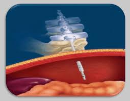 Pneumoperitoneumin aiheuuamat komplikaabot Tahaton endobronkiaali-