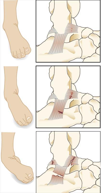 9 KUVA 4. Nilkan lateraalisten ligamenttivammojen luokittelu, asteet I-III (Haapasalo ym. 2011.) Akuuttihoitona parin ensimmäisen päivän aikana on kolmen K:n hoito eli kylmä, koho ja kompressio.