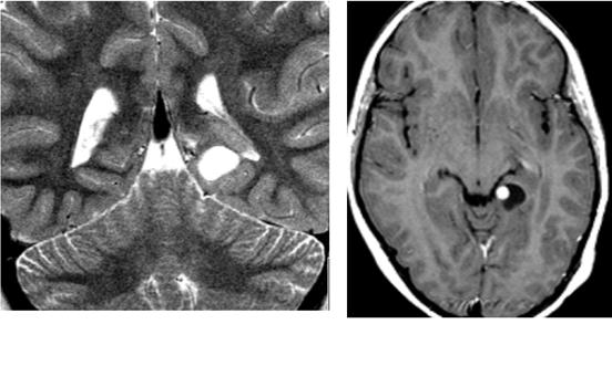 A B C Kuva 5. Oikealla ohimolohkon takaosassa ja takaraivolohkossa sijaitseva fokaalinen kortikaalinen dysplasia näkyy FLAIR- (A) ja T2-kuvissa (B) signaalinvoimistumana kuorikerrosalueella.