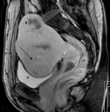 TOIMENPIDERADIOLOGIA (Williams ym. 2006). Myoomapotilaista 20 50 %:lla on arvioitu olevan oireita (Stovall 2001).