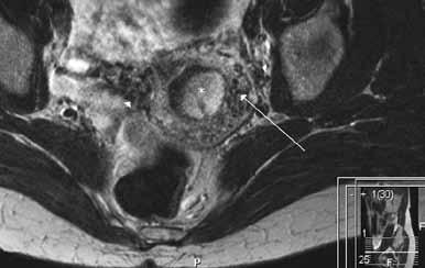 TOIMENPIDERADIOLOGIA * A B C D Kuva 6. 43-vuotiaalla naisella oli esiintynyt kuukauden ajan veristä vuotoa emättimestä.