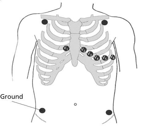 10 Kuvio 1. Mason-Likar -kytkennät (Fletcher ym. 2013, Welinder ym. 2014) 2.3.3 Verenpaine Verenpaineella tarkoitetaan valtimoiden sisäistä painetta, joka syntyy silloin, kun sydän supistuu ja pumppaa verta valtimoihin.