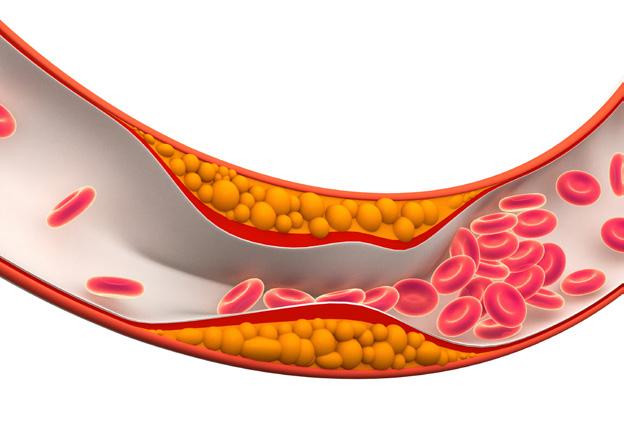 So having too much cholesterol and triglycerides in the blood increases the risk of getting cardiovascular diseases, such as a coronary heart disease, a stroke, and diseases which affect the