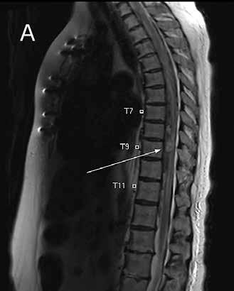 TAPAUSSELOSTUS TAULUKKO.. Kompressiivisen vaurion syitä Ei-neoplastiset Neoplastiset Trauma Spondyloosi Välilevyn pullistuma Spinaalistenoosi Infektiot (absessi, tuberkuloosi jne.