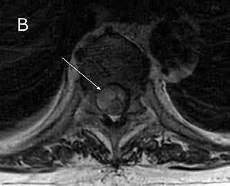 ) Selkäydinkanavan verenvuodot (epiduraali-, subduraali- ja subaraknoidaalivuodot) Syringomyelia Epämuodostumat Araknoideakysta Pagetin tauti Osteoporoosi Epiduraaliset kasvaimet Intraduraaliset