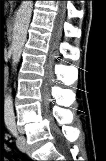 rangan alueella hidastunut, mikä sopi selkäydinkanavan sisäiseen verenvuotoon. Oireisto eteni nopeasti, ja potilaalle kehittyi hankala proksimaalisesti painottuva motorinen parapareesi.