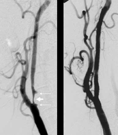 TOIMENPIDERADIOLOGIA A Kuva 1. Potilaalle oli tehty v. 1978 kaulavaltimon puhdistusleikkaus oikealle ja 20 vuotta myöhemmin vasemmalle.