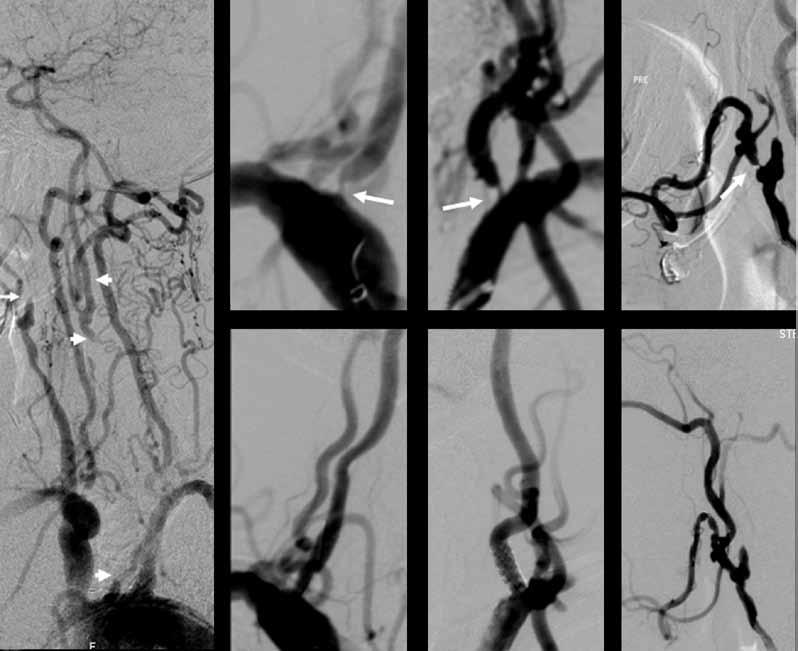 TOIMENPIDERADIOLOGIA toimenpiteessä (4 %), mikä johtui tiukasta, kalkkiutuneesta ahtaumasta. Näissä tapauksissa stenttaus tehtiin ilman suojalaitetta eikä komplikaatioita tullut.