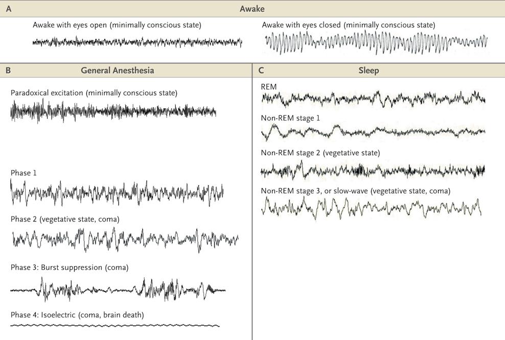 EEG on epäspesifinen mittari Brown et al, NEJM 2010 PERIOPERATIVE MEDICINE fmri Fig. 2. Large-scale network connectivity is partially preserved during propofol-induced unconsciousness.