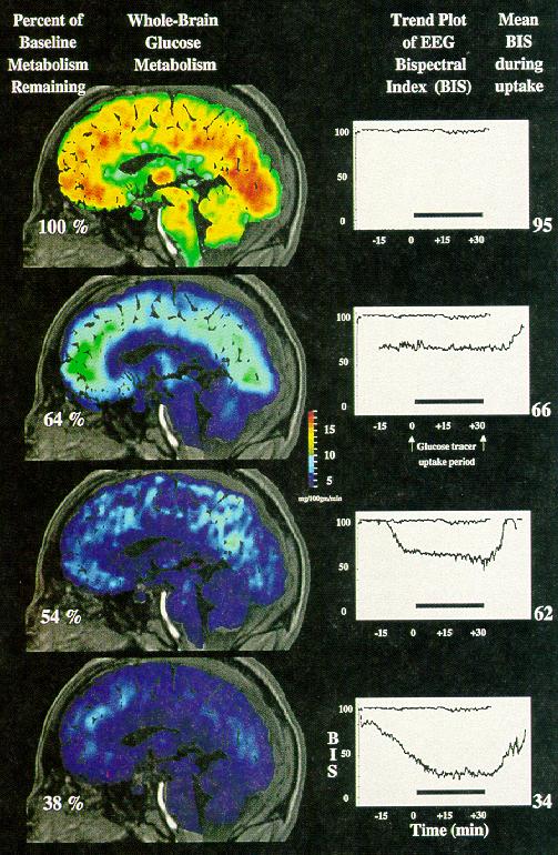 Yleisanestesia: Metabolia vs.