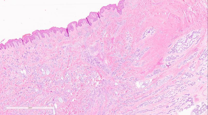 Eccrine
