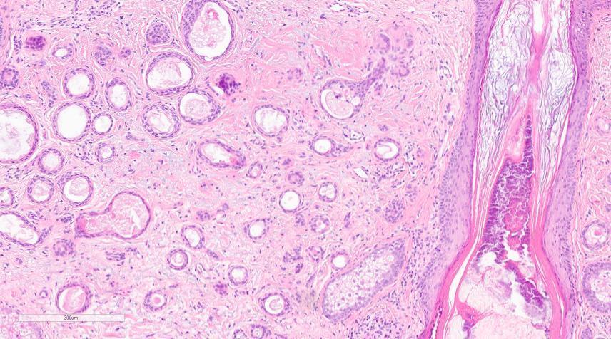Syringoma