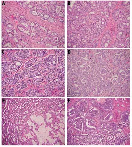 KUVA 3. Huomioitavia seikkoja rauhasrakenteeseen perustuvassa Gleasonin erilaistumistavassa (Gleason grade pattern). A. Gleason 3. Avoimia rauhasrakenteita, joissa nähdään osin musinoosia eritettä.