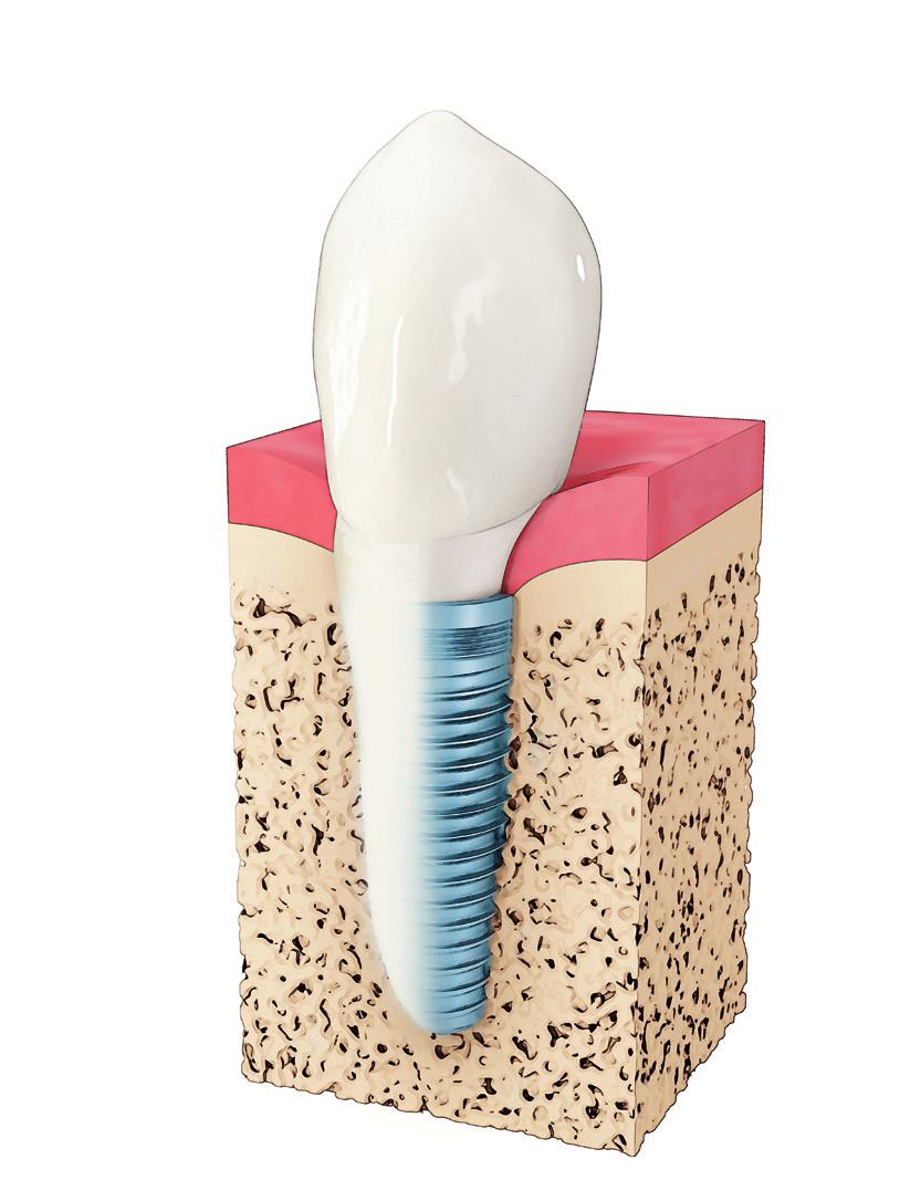 Hammasimplanteista on monia etuja Mikä hammasimplantti on? Hammasimplantti toimii uuden hampaan juurena.