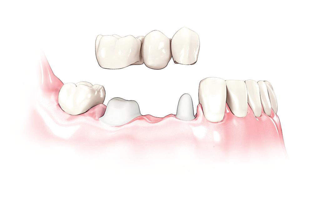 Hampaiden korvaaminen hammasimplanteilla Hammasimplantit asennetaan leukaluuhun, ja ne käyttäytyvät aivan kuin omien hampaidesi juuret. Tämän toimenpiteen ansiosta terveisiin hampaisiin ei kosketa.