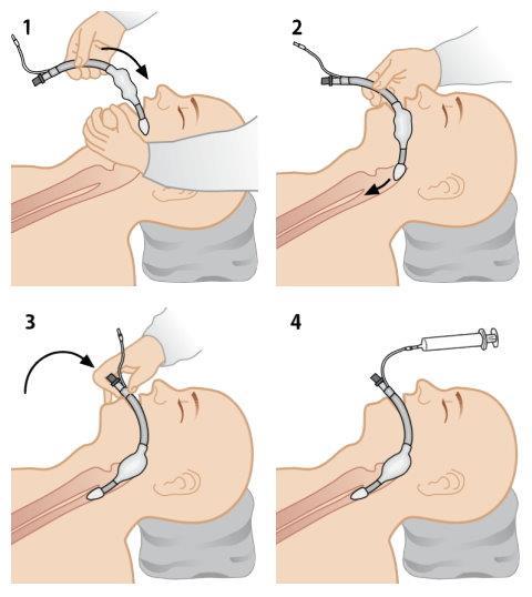 4.2 Larynx-tuubin käytön tekninen toteuttaminen Larynxtuubi asetetaan potilaalle potilaan pään ollessa neutraaliasennossa.